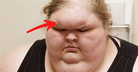 samples obese fat forehead